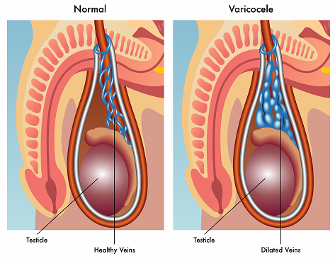 normal vein vs varicocele vein