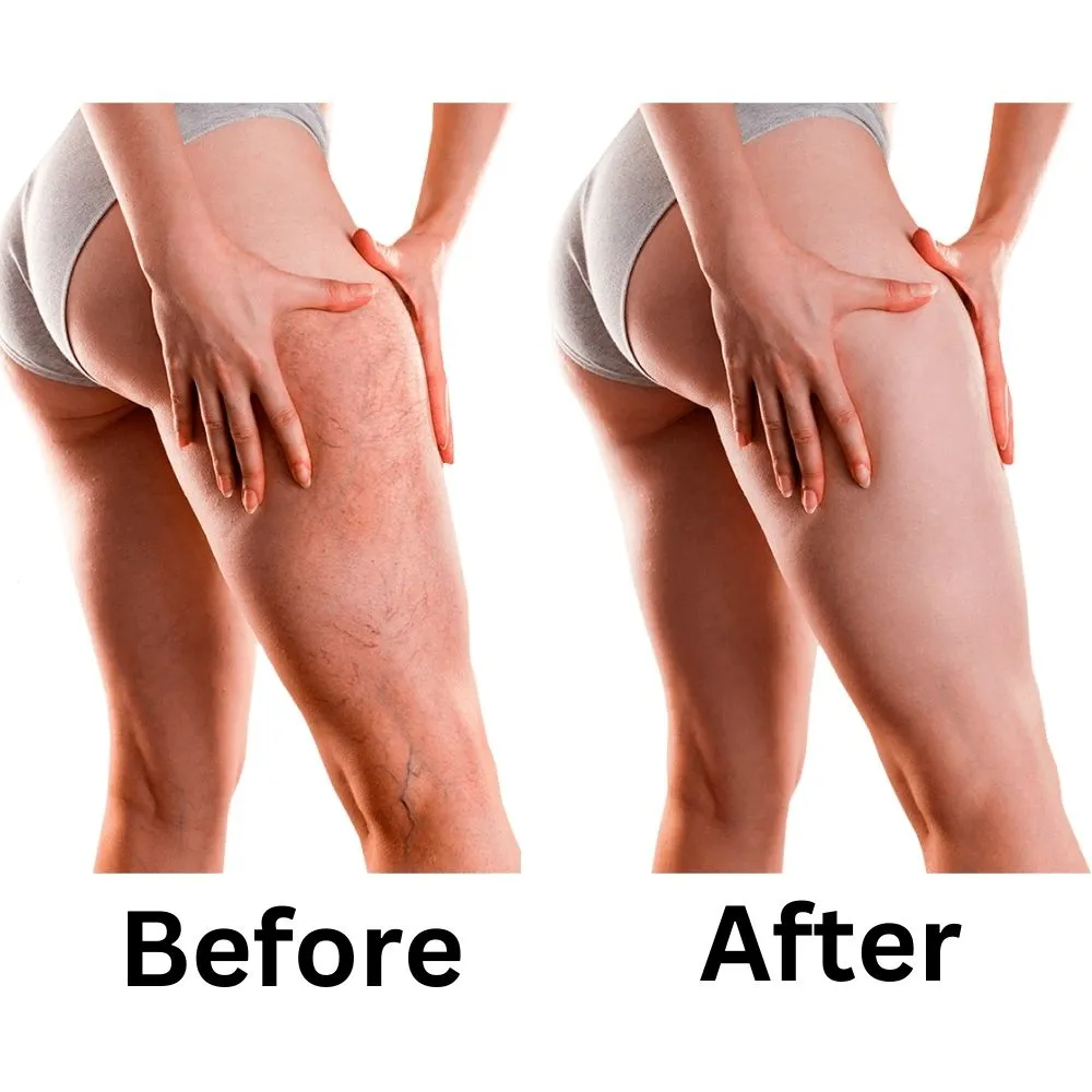 Result before and after using veniselle varicose vein cream