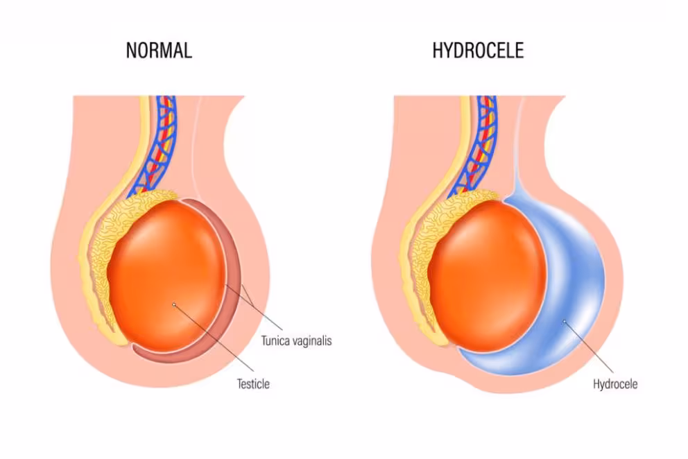 Testis Fill with Hydrocele