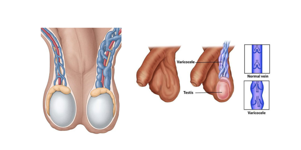 Male Testicular Problem Varicocele