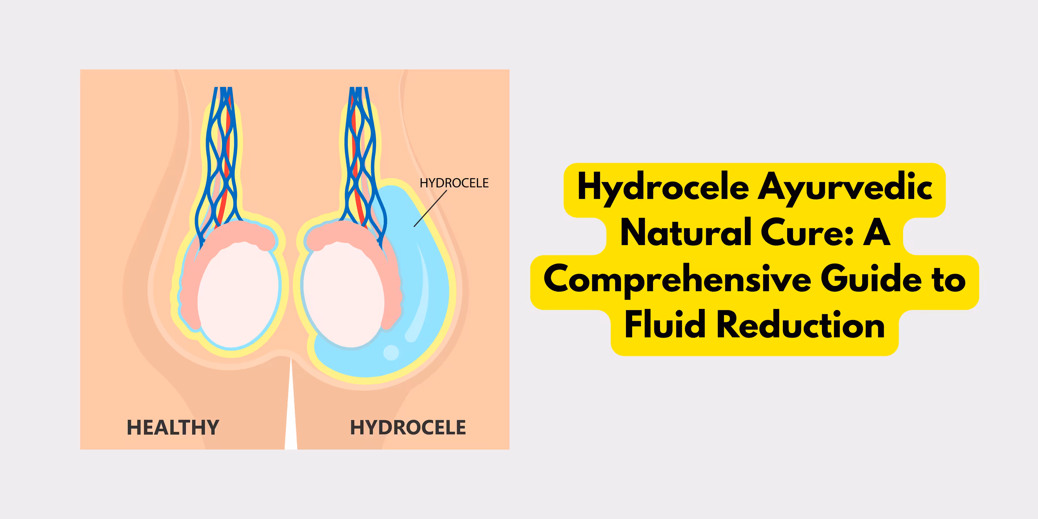Hydrocele Ayurvedic Natural Cure: A Comprehensive Guide to Fluid Reduction