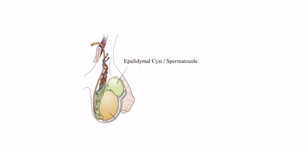 Image of Epididymal cyst or spermatocele