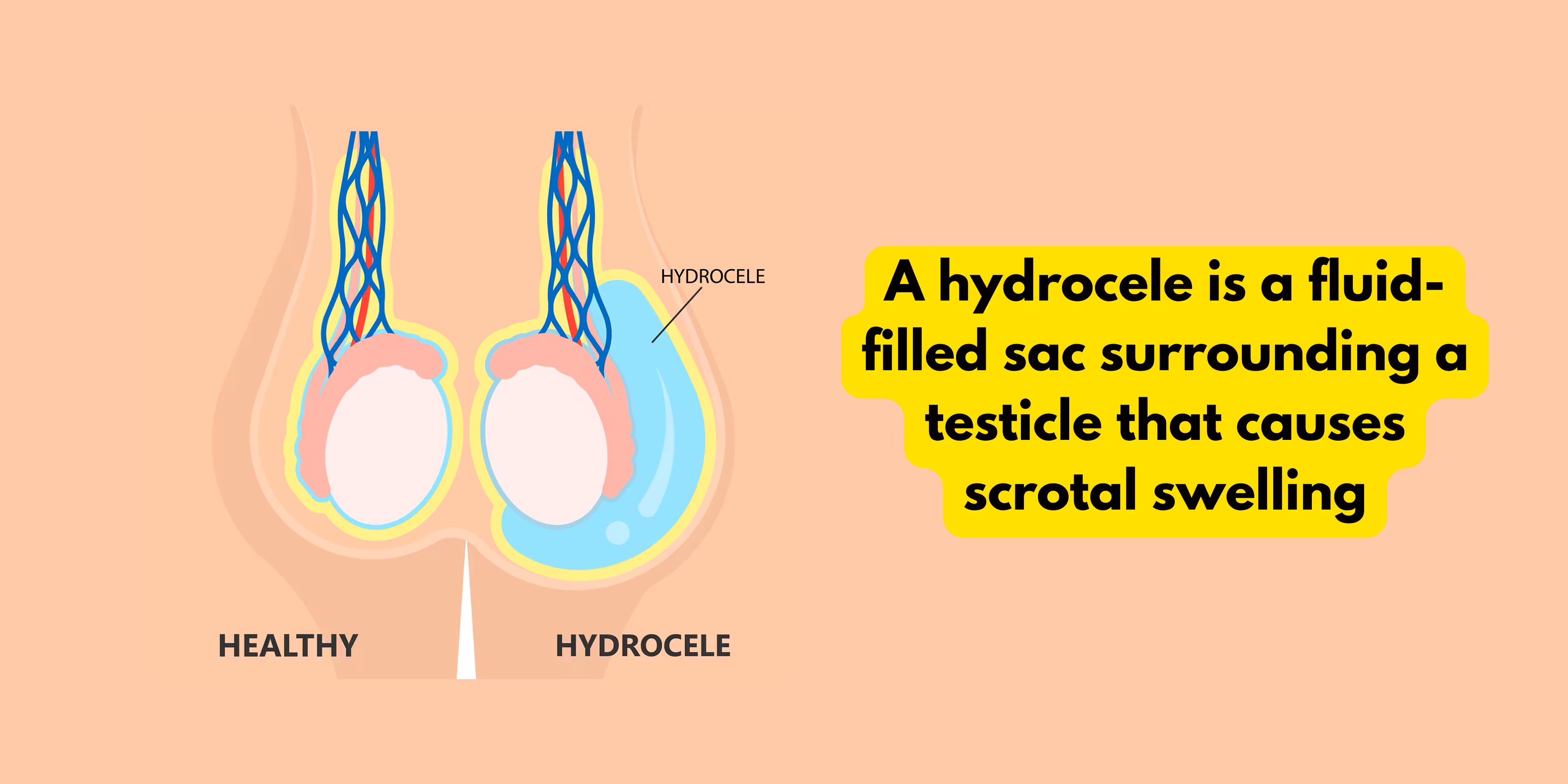Hydrocele Natural Cure - What is Hydrocele?