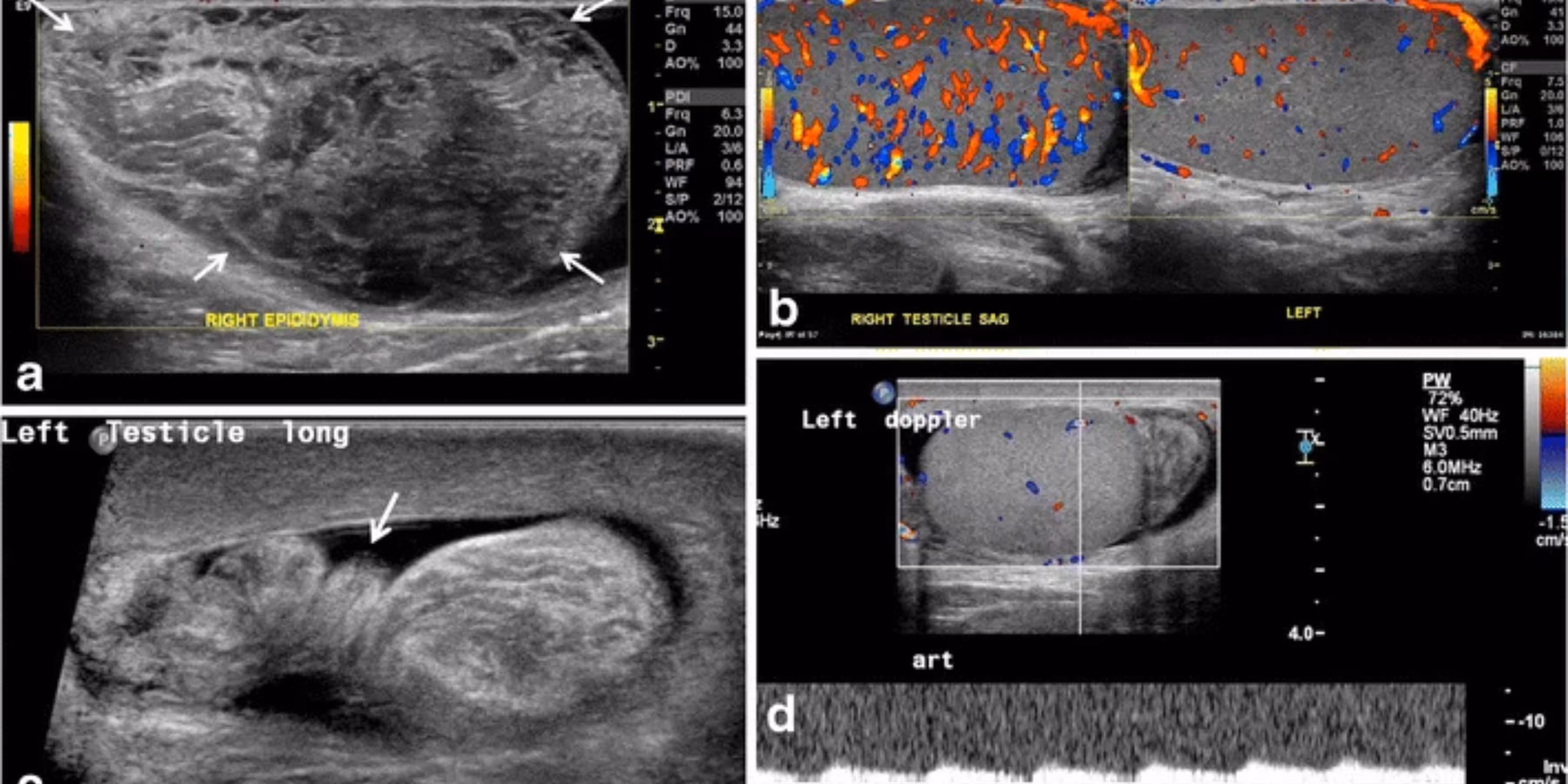 Ultrasound of Chronic Testicular Orchialgia